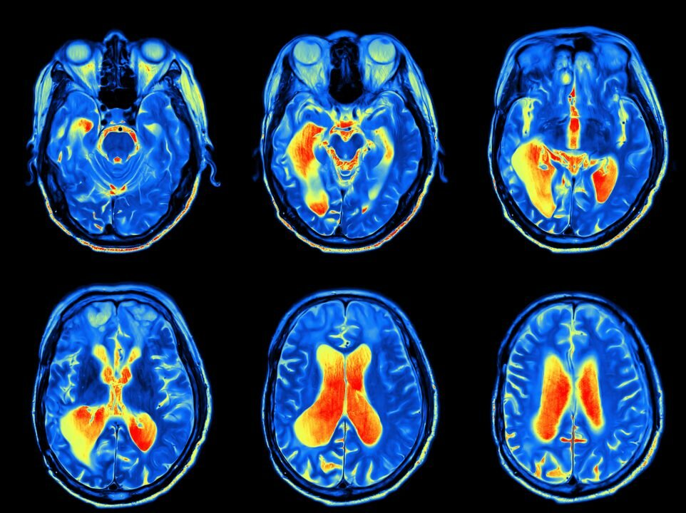 brain scan mri neuroscience
